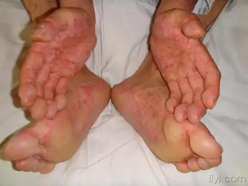 看图识病!------------重症多形红斑型药疹