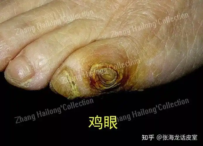 鸡眼与胼胝:治疗失败的原因与正确处理 - 知乎