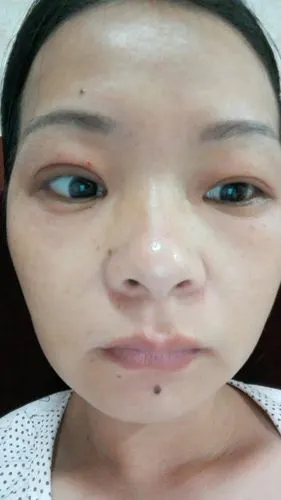 做了纳米无痕双眼皮医生说是线结反应把线拆了一个月了怎么还是肿的