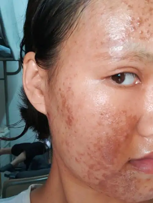 果酸焕肤第二天 比昨天的结痂部位更暗沉了