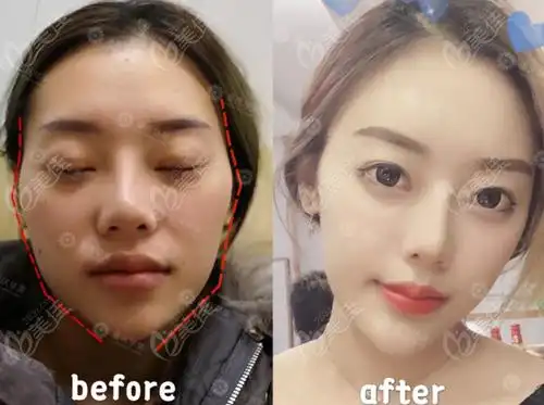 陈凯医生全脸脂肪填充效果图