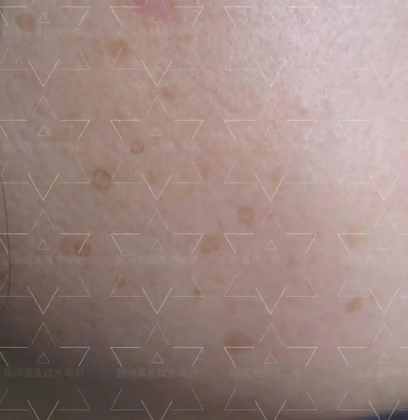 何为空心斑～ 也叫汗孔角化症, 是一种少见的遗传性皮肤病,无自觉症状