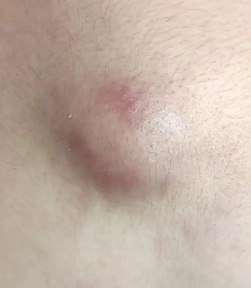 毛囊炎_毛囊炎 - 好大夫在线