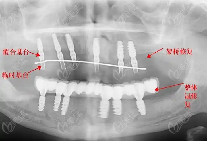 allon4桥架式半口即刻负重种植牙多少钱要清楚它的优缺点也要搞懂