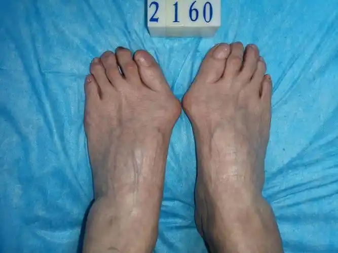 重度拇外翻