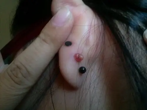 你这是不是一般疙瘩也不是水泡,而是肉瘤.