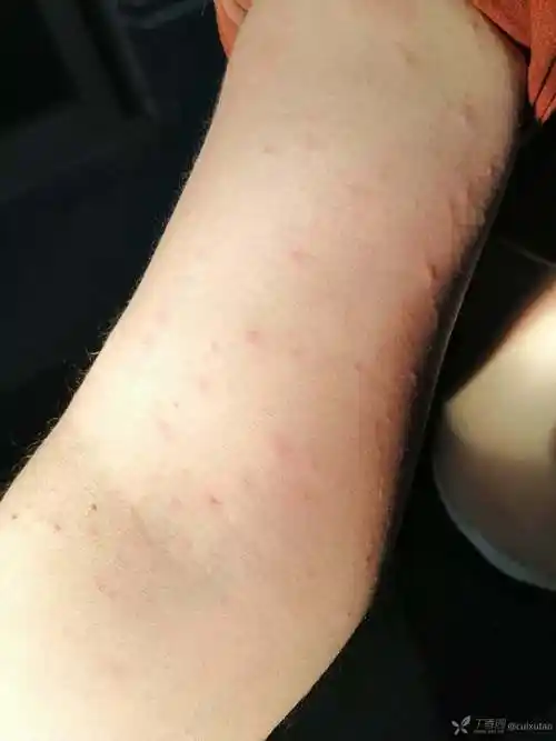 皮疹不痒请教是什么皮肤病