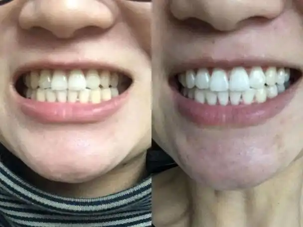 一口黄牙太难看?牙齿美白的3个小妙招,省钱又简单,不妨试一试