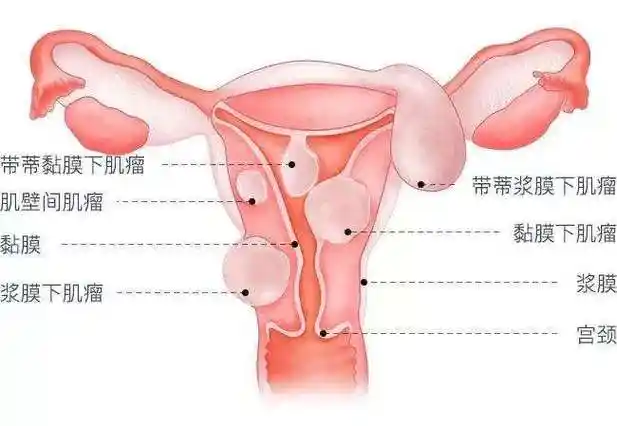 成都中医肿瘤医院:女性子宫肌瘤的自检方法?
