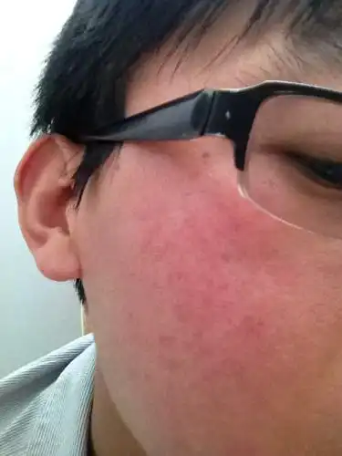 过敏性油性皮肤,红血丝.听说avene化妆品挺好,具体用哪个好?