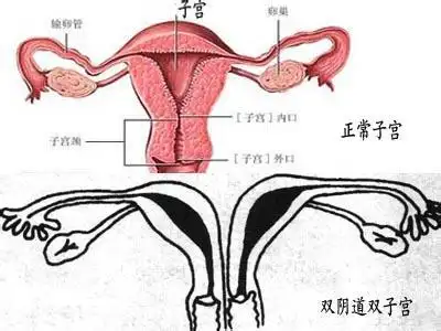 双子宫是怎么回事女性双子宫的危害不容忽视
