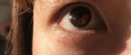 眼睛下长了红点有点痒,摸着有涩感,好长时间了一直不下去,请问用什么