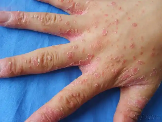 急性点滴型银屑病