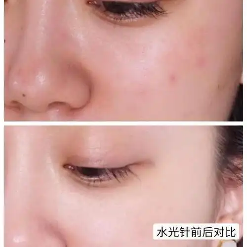 水光针可以改善肌肤,但要注意可能出现的副作用和注意事项