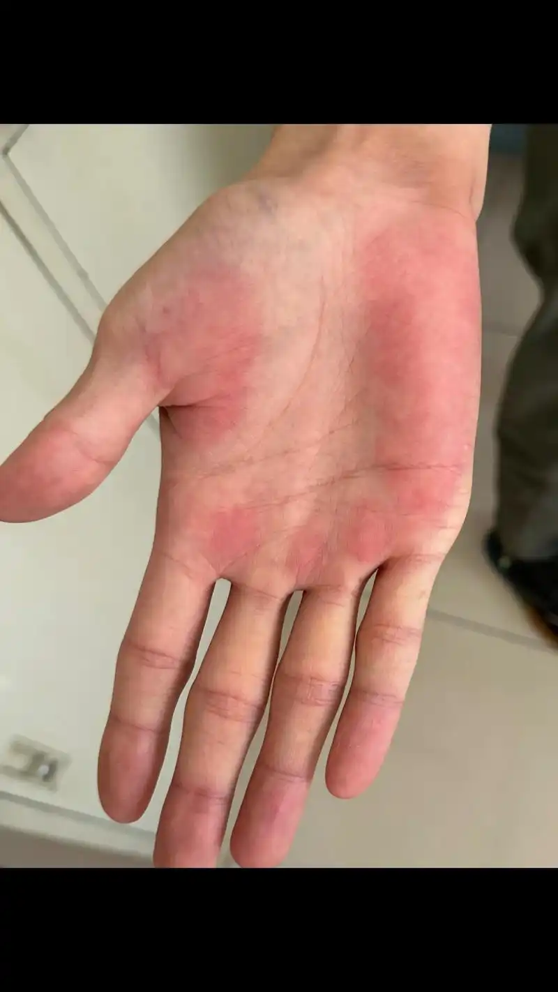 仅仅一个月,肝癌到过世,肝掌就是前兆