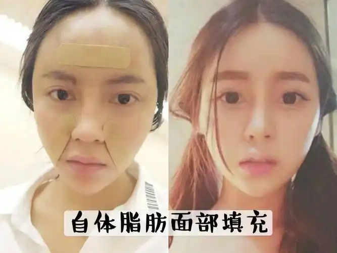 自体脂肪面部填充手术前后效果对比