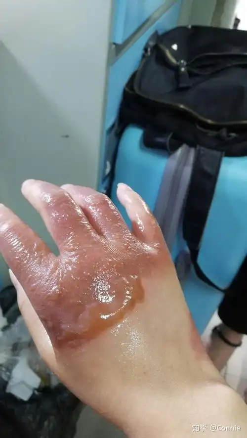 手被开水烫伤了怎么办