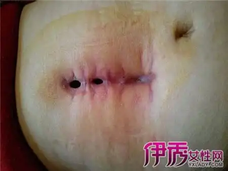 【图】包皮手术后伤口愈合不了怎么办? 5个处理方法帮助你