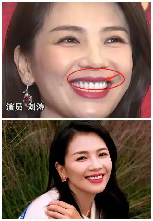 刘涛和男演员拍吻戏,王珂:悠着点嘬,她这一口假牙花了300万