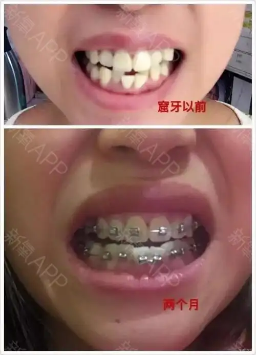 以前每次拍照都不敢笑,因为有虎牙还有一点嘴巴前突,_圈子-新氧美容