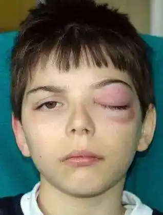 眼睑的炎症,眼睑过敏 2.肾脏的疾病,甲状腺功能低下等情况都能够引起.