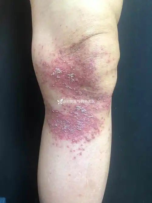 典型皮损接触性皮炎