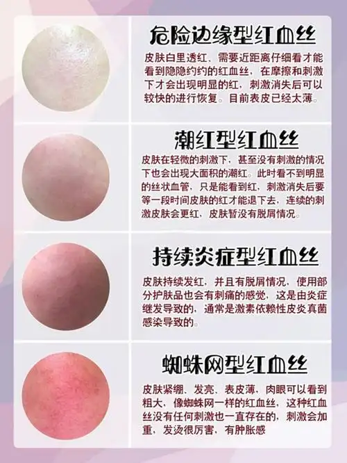 任何皮肤问题去红血丝是第一步来看看三甲医院医生怎么说