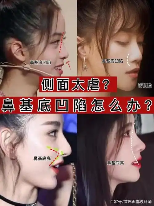 侧脸太虐快来测测是不是鼻基底凹陷