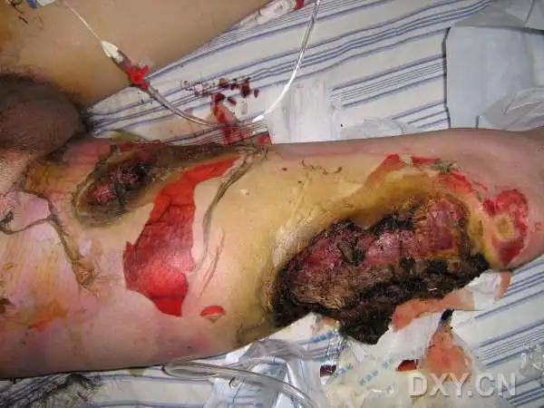 〔讨论〕严重的双下肢高压电击伤 - 修复重建和烧伤整形 -丁香园论坛