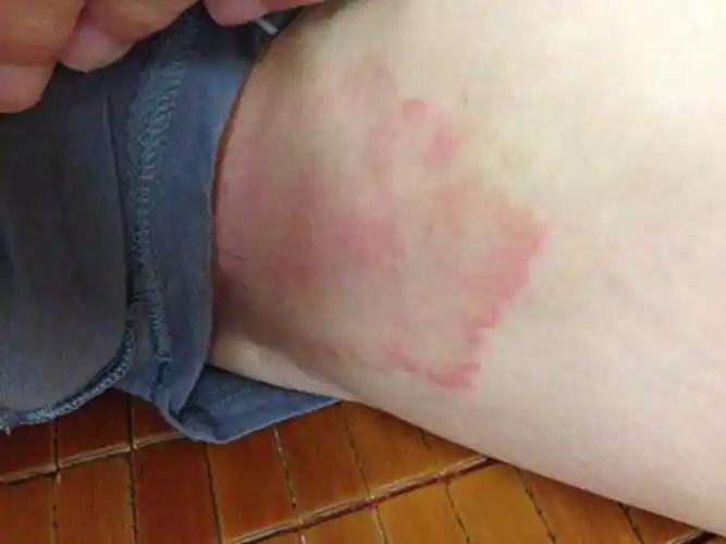 成年人严重股癣局部图片_有来医生