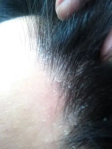 冬天头皮干的有好多头皮屑,都是大块的,集中在前发际线,怎么治?