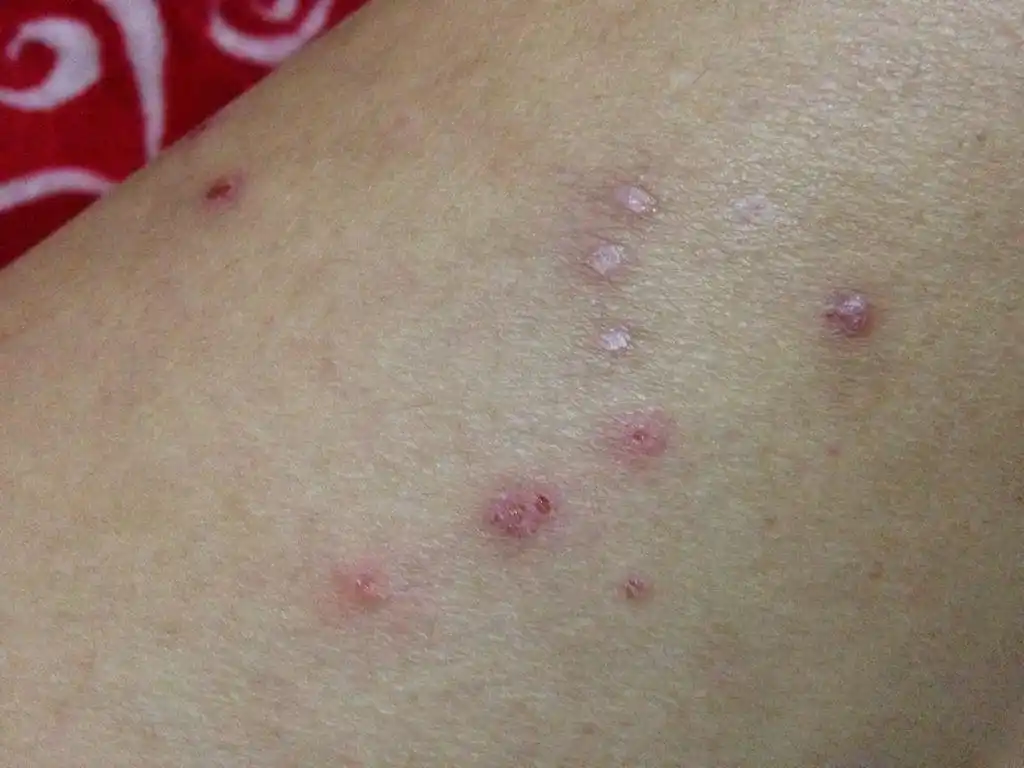 去医院看有说是丘疹有说是湿疹,还有说紫外线过敏不能晒,到现在也没