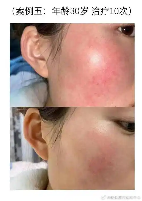 修复受损的皮肤屏障是治疗敏感性皮肤的重要措施.