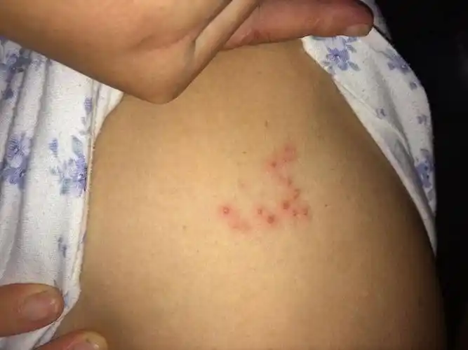 脖子淋巴瘤早期图片_有来医生