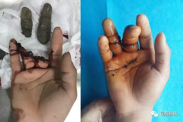 濒临截肢的肢体得以挽留,生命垂危的险情得以化解.