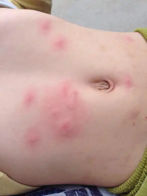 2岁小孩身上长红疙瘩,一块一块的,很痒,有半月了,这是什么皮肤病?