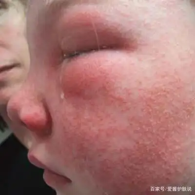 肌肤清洁会烂脸?护肤新手上路必看!