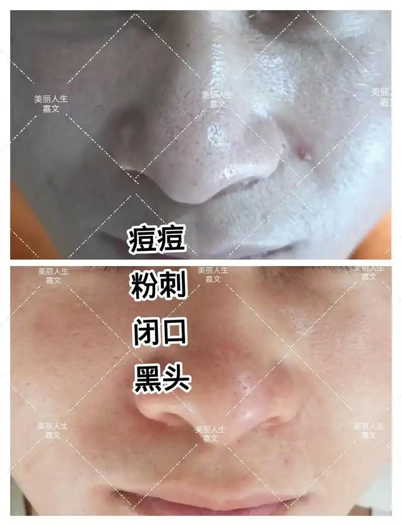 分享一下 店里帮顾客做好的皮肤小问题, 和闭口#痘痘黑头粉刺 - 抖音