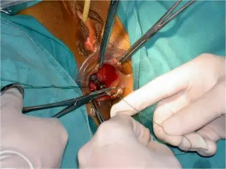 pph手术即吻合器痔环切术,适用于各类痔疮,尤其是重度内痔和部分直肠