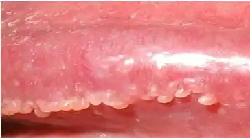 苹果绿 保健常识冠状沟的珍珠疹,一般多年来皮疹大小和数量都没有明显