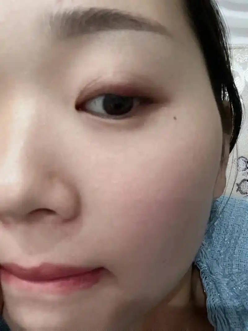 眼皮里面长了一个硬疙瘩,长了好几年了一直也没管它,平时也就是 - 抖