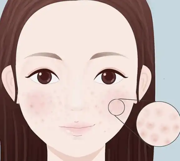 这是一篇来自蕾特恩分享:关于"毛孔粗大"的解惑科普