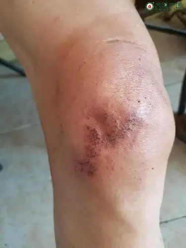 膝关节积液如何治疗