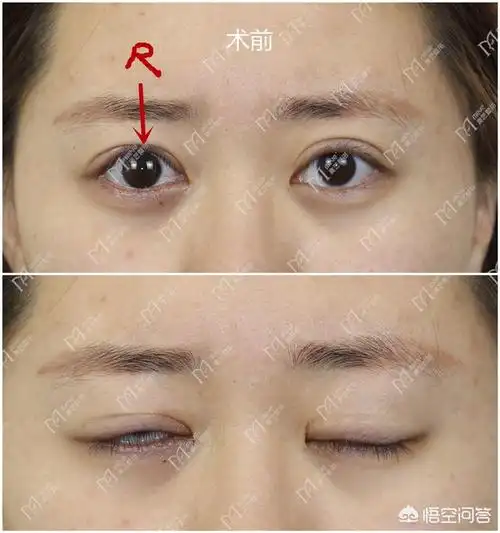 头条问答 - 什么是眼睑退缩?原因是什么?(2个回答)