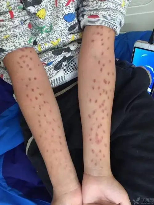 如此密集对称的双上肢瘀斑难不成是自残