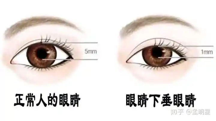 双眼皮也会上睑下垂吗?