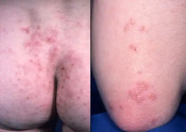 易被漏诊的疱疹样皮炎(附图)