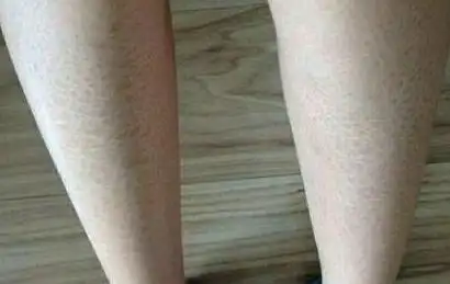 蛇皮病进行缓解的护理办法_蛇皮病_青岛皮肤病研究院