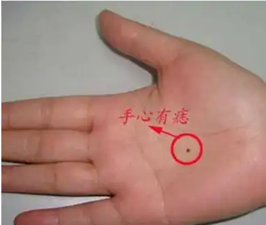 女人手背长痣代表了什么呢?