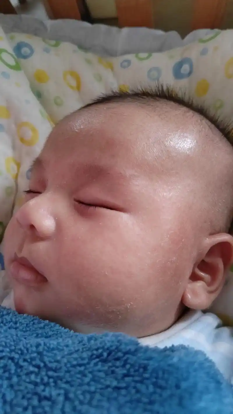 过敏的宝宝真的是费妈又费钱.